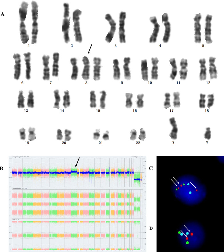 Prenatal diagnosis of trisomy 8 mosaicism, initially identified by cffDNA screening.