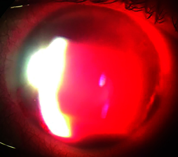 Large Hyphema following Femtosecond Laser-assisted Cataract Surgery (FLACS) and Trabectome Resulting in Endocapsular Hematoma.