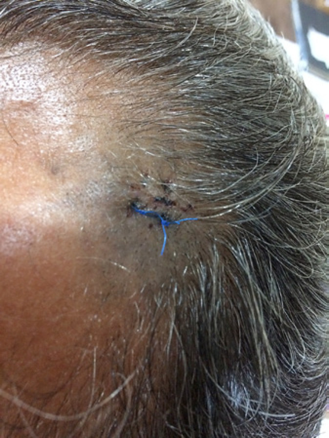 A Report of Unusual Case of Acquired Dermal Melanocytosis on the Scalp of a Caucasian Man with a Literature Review.