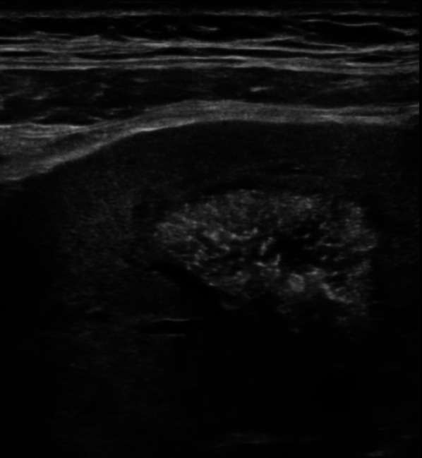 Medullary sponge kidney: unusual finding in kidney transplant recipient.