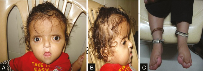 Craniosynostosis: A Pediatric Neurologist's Perspective.