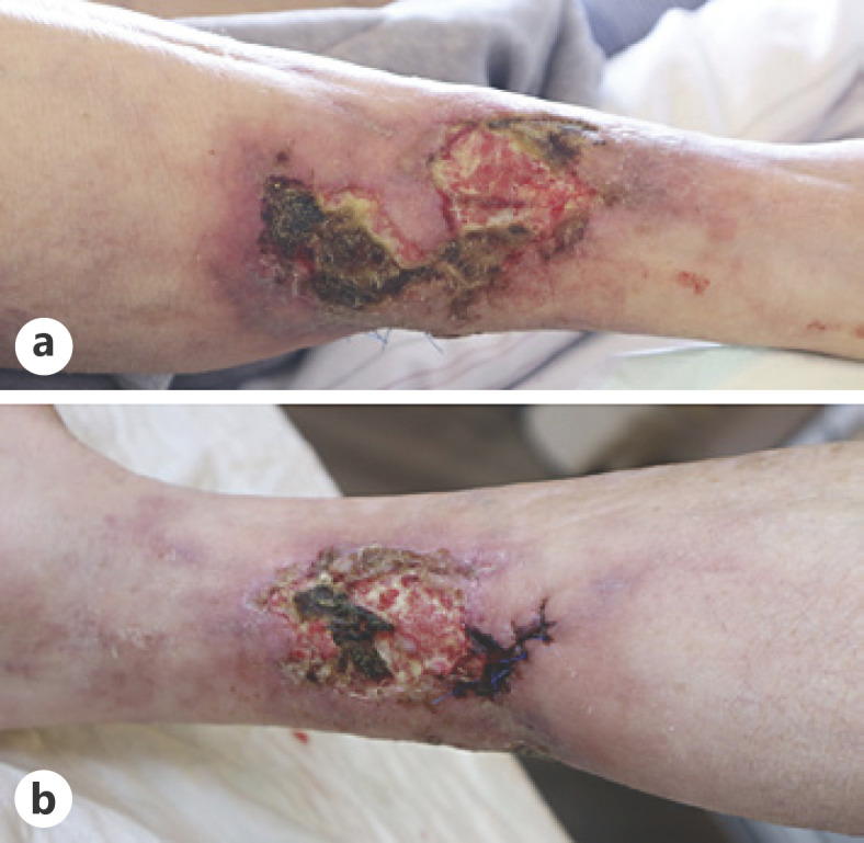 Successful Novel Treatment of Nonuremic Calciphylaxis with Sodium Thiosulfate and Iloprost: A Case Report.