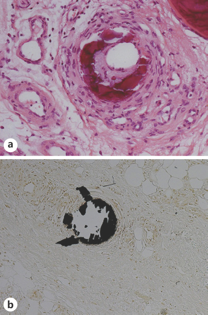 Successful Novel Treatment of Nonuremic Calciphylaxis with Sodium Thiosulfate and Iloprost: A Case Report.