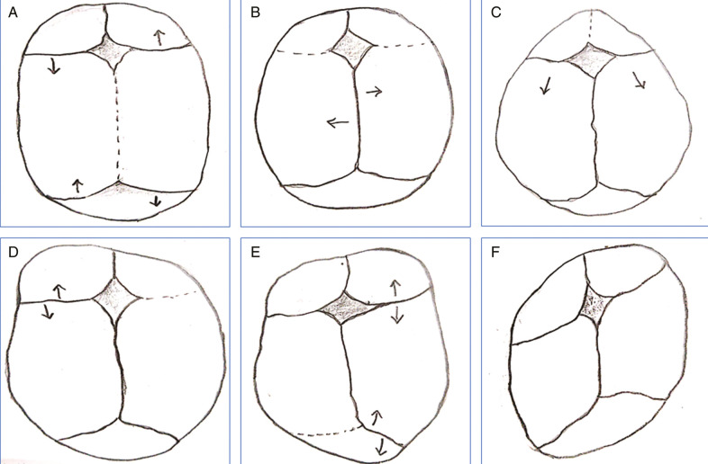 Craniosynostosis: A Pediatric Neurologist's Perspective.