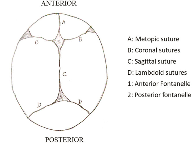 Craniosynostosis: A Pediatric Neurologist's Perspective.