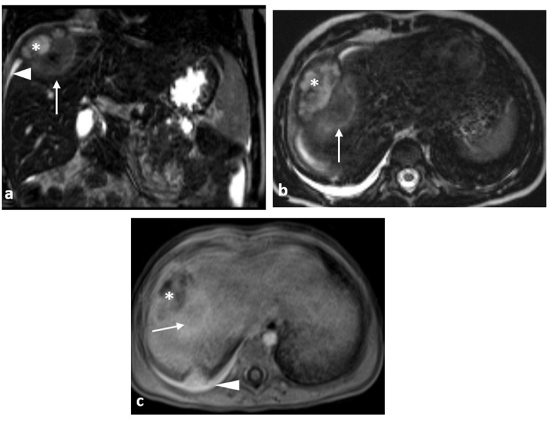 Liver Abscess Complicated with an Inflammatory Myofibroblastic Tumor.