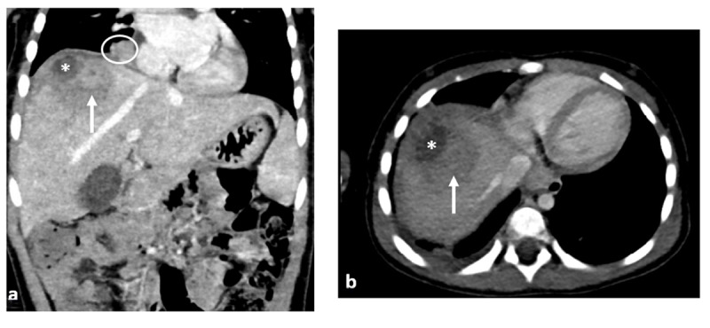 Liver Abscess Complicated with an Inflammatory Myofibroblastic Tumor.