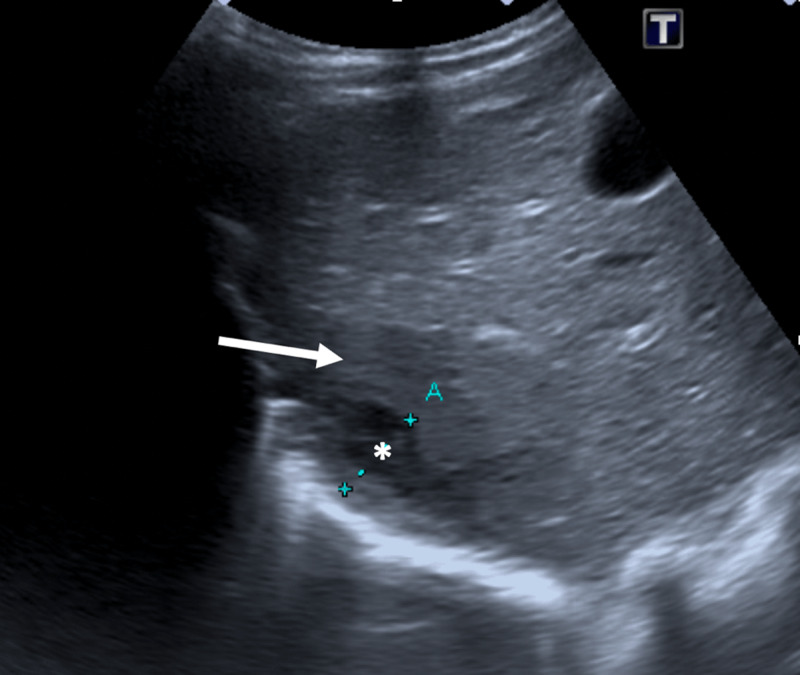 Liver Abscess Complicated with an Inflammatory Myofibroblastic Tumor.