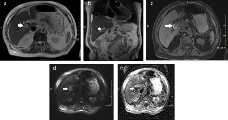 Bacteraemia and Associated Complications on Imaging as a Clue to Colorectal Malignancy.