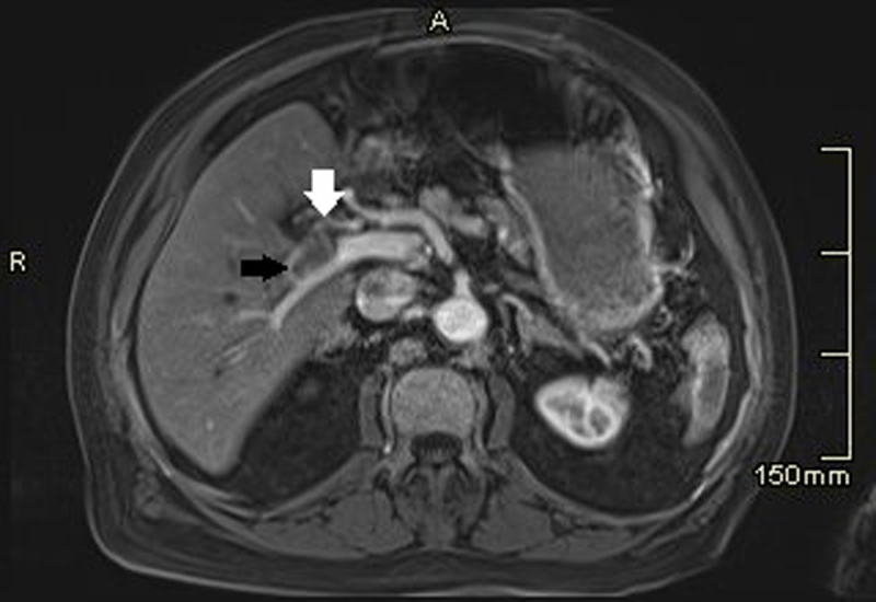 Bacteraemia and Associated Complications on Imaging as a Clue to Colorectal Malignancy.