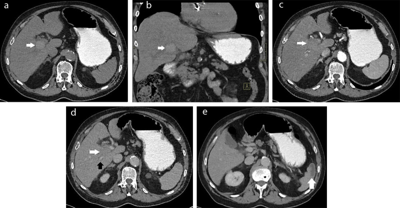 Bacteraemia and Associated Complications on Imaging as a Clue to Colorectal Malignancy.