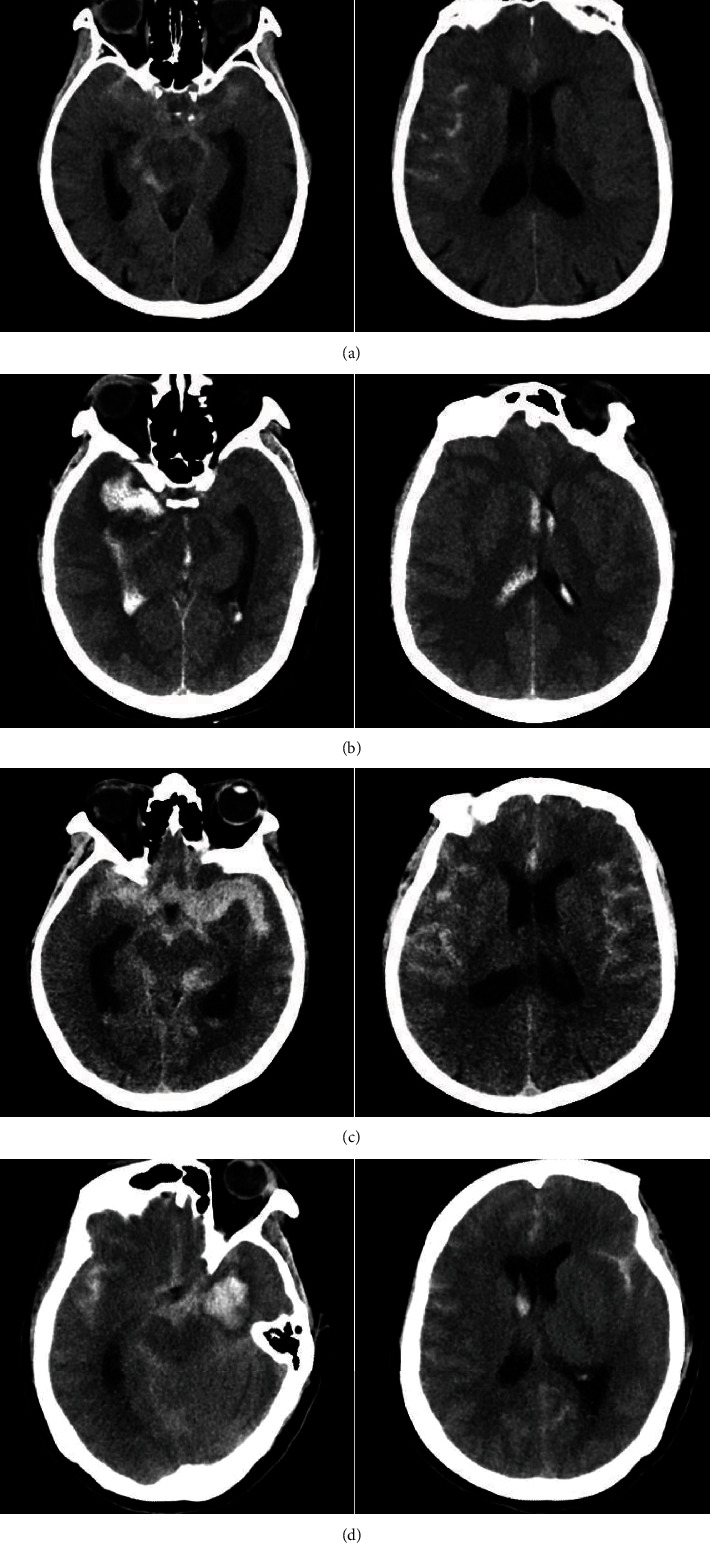 CTA Study of Ruptured Aneurysms of the Posterior Communicating Artery.