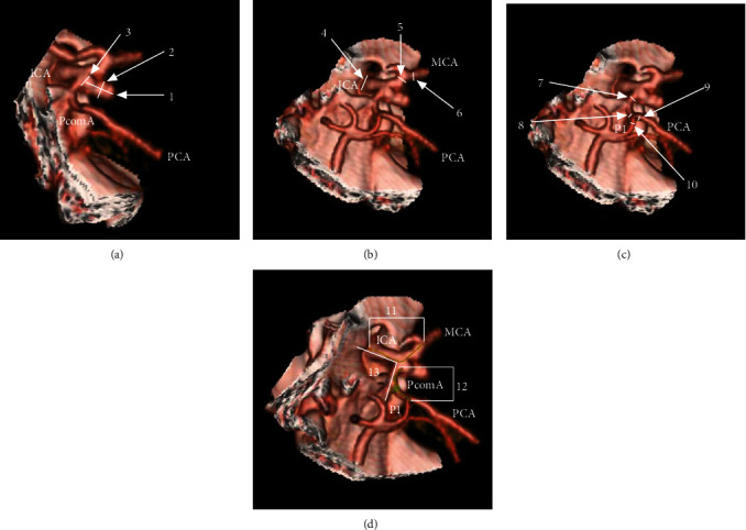 CTA Study of Ruptured Aneurysms of the Posterior Communicating Artery.