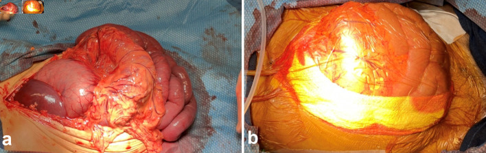 Development of Early Abdominal Compartment Syndrome Leading to Emergent Decompressive Laparotomy in Full-Thickness Burn Injury.