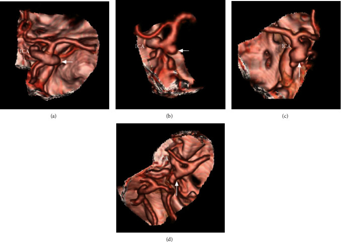 CTA Study of Ruptured Aneurysms of the Posterior Communicating Artery.