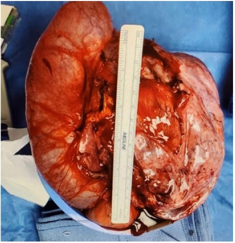 A case of congenital cloacal exstrophy/omphalocele-exstrophy-imperforate anus-spinal defects syndrome and a successful pregnancy.