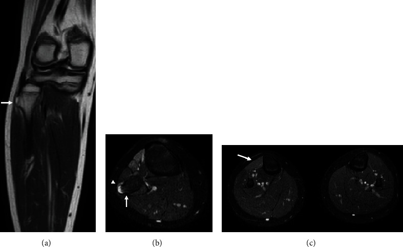 Peroneal Nerve Palsy Caused by Proximal Fibular Solitary Osteochondroma: Case Report and Literature Review.