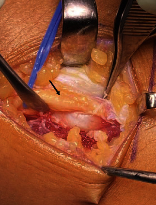 Peroneal Nerve Palsy Caused by Proximal Fibular Solitary Osteochondroma: Case Report and Literature Review.