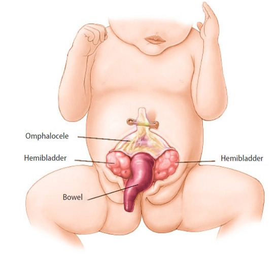 A case of congenital cloacal exstrophy/omphalocele-exstrophy-imperforate anus-spinal defects syndrome and a successful pregnancy.