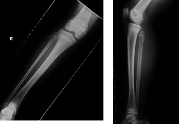 Peroneal Nerve Palsy Caused by Proximal Fibular Solitary Osteochondroma: Case Report and Literature Review.
