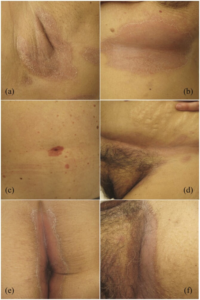 Prevalence of inverse psoriasis subtype with immune checkpoint inhibitors.