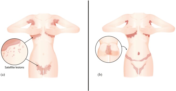 Prevalence of inverse psoriasis subtype with immune checkpoint inhibitors.