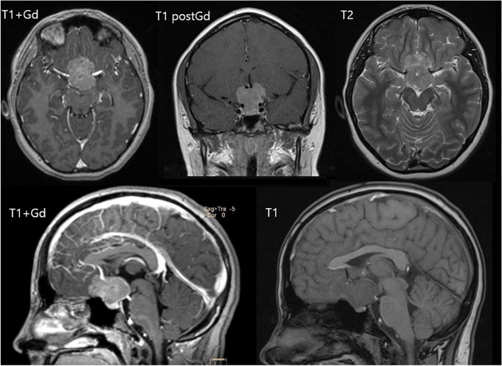 Trans-eyebrow supraorbital endoscope-assisted keyhole approach to suprasellar meningioma in pediatric patient: case report and literature review.