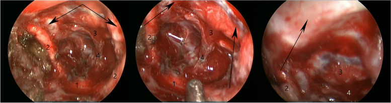 Trans-eyebrow supraorbital endoscope-assisted keyhole approach to suprasellar meningioma in pediatric patient: case report and literature review.