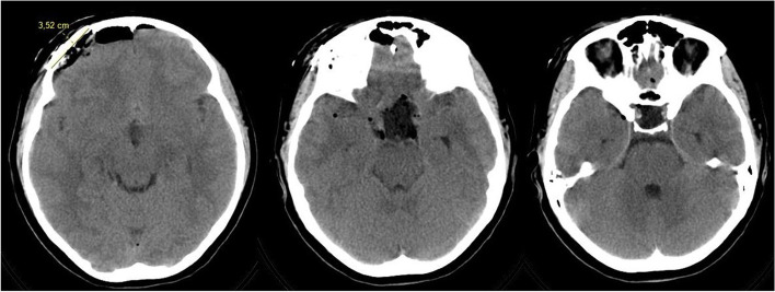 Trans-eyebrow supraorbital endoscope-assisted keyhole approach to suprasellar meningioma in pediatric patient: case report and literature review.