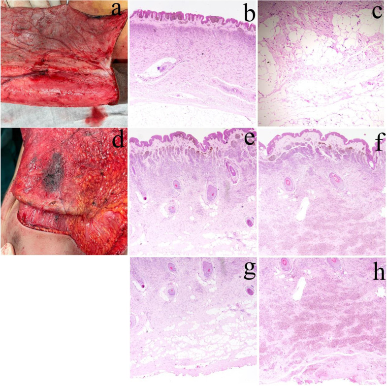 Association of novel MUC16, MAP3K15 and ABCA1 mutation with giant congenital melanocytic nevus.