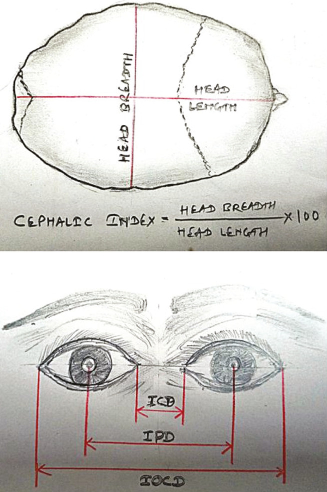 Evaluation and Management of Nonsyndromic Craniosynostosis.