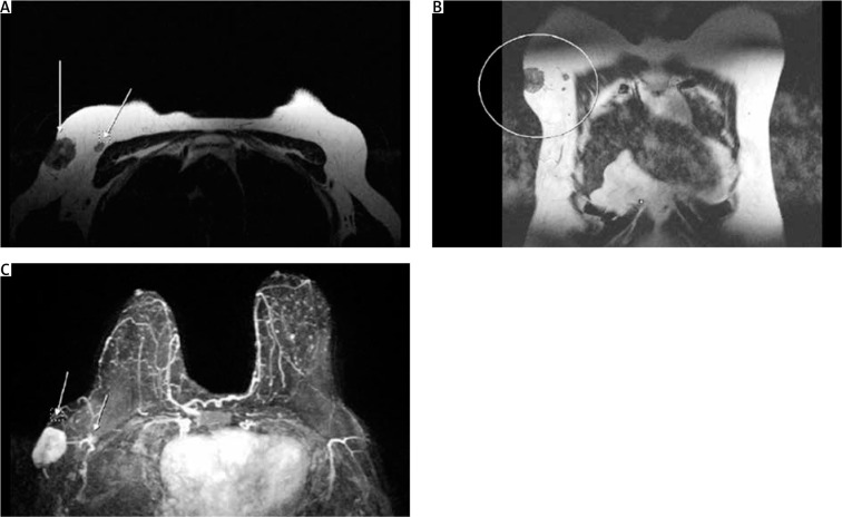 Ectopic breast carcinoma.