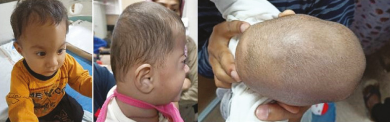 Evaluation and Management of Nonsyndromic Craniosynostosis.