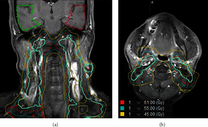 Spotted Temporal Lobe Necrosis following Concurrent Chemoradiation Therapy Using Image-Guided Radiotherapy for Nasopharyngeal Carcinoma.