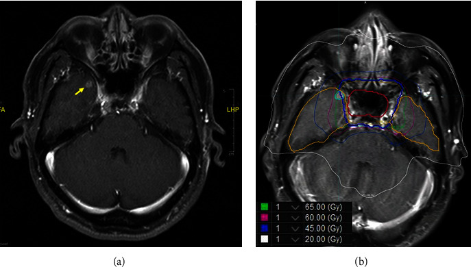 Spotted Temporal Lobe Necrosis following Concurrent Chemoradiation Therapy Using Image-Guided Radiotherapy for Nasopharyngeal Carcinoma.