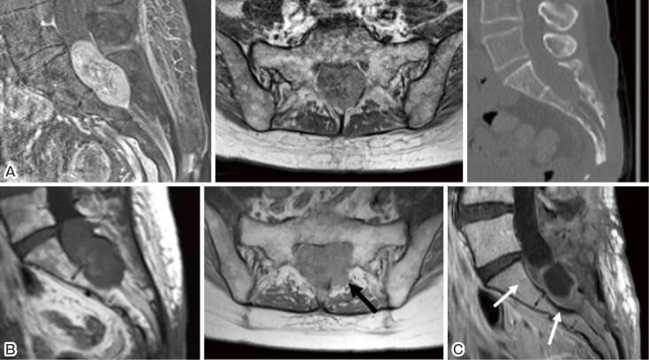 Delayed Recurrence of Choroid Plexus Carcinoma in the Sacral Spinal Cord 17 Years after Its Initial Presentation.