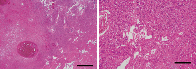 Delayed Recurrence of Choroid Plexus Carcinoma in the Sacral Spinal Cord 17 Years after Its Initial Presentation.