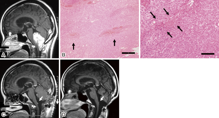 Delayed Recurrence of Choroid Plexus Carcinoma in the Sacral Spinal Cord 17 Years after Its Initial Presentation.