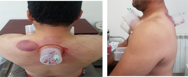 Interactive Effects of Nutrition Modification and Wet Cupping on Male Patients with Refractory Stable Angina.