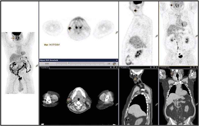 Basal Cell Adenocarcinoma Arising from the Parotid Gland.