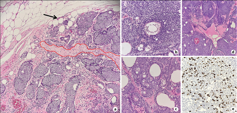 Basal Cell Adenocarcinoma Arising from the Parotid Gland.