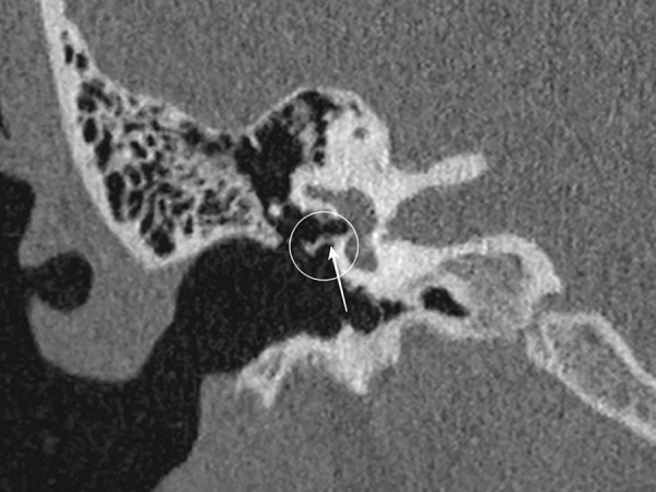 Stapedotomy in Congenital Stapes Ankylosis with Mobile Footplate: A Case Report.