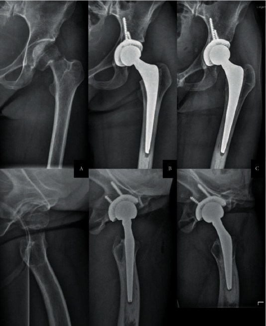 Asymptomatic Periprosthetic Joint Infection of the Hip with High-Virulence Pathogens: Report of Two Cases.