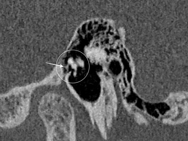 Stapedotomy in Congenital Stapes Ankylosis with Mobile Footplate: A Case Report.