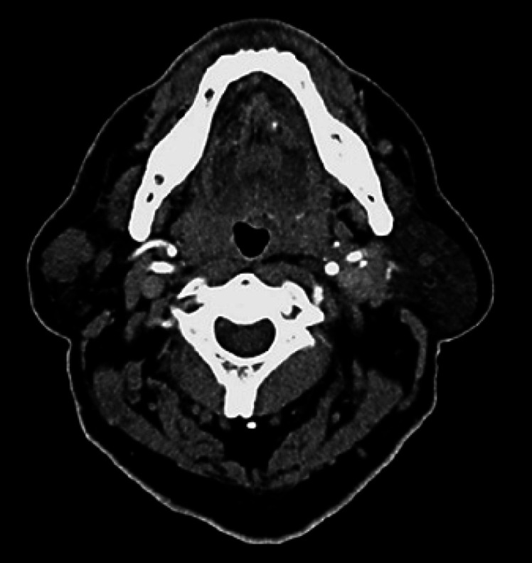 Basal Cell Adenocarcinoma Arising from the Parotid Gland.