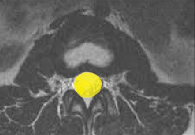 Variation of Torg-Pavlov ratio with age, gender, vertebral level, dural sac area, and ethnicity in lumbar magnetic resonance imaging.