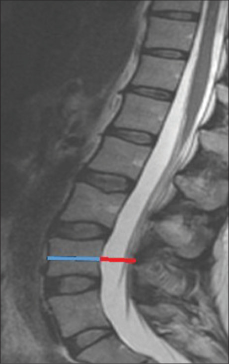 Variation of Torg-Pavlov ratio with age, gender, vertebral level, dural sac area, and ethnicity in lumbar magnetic resonance imaging.