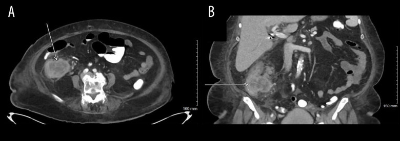 Sarcomatoid Carcinoma of the Ascending Colon: A Case Report and Literature Review.