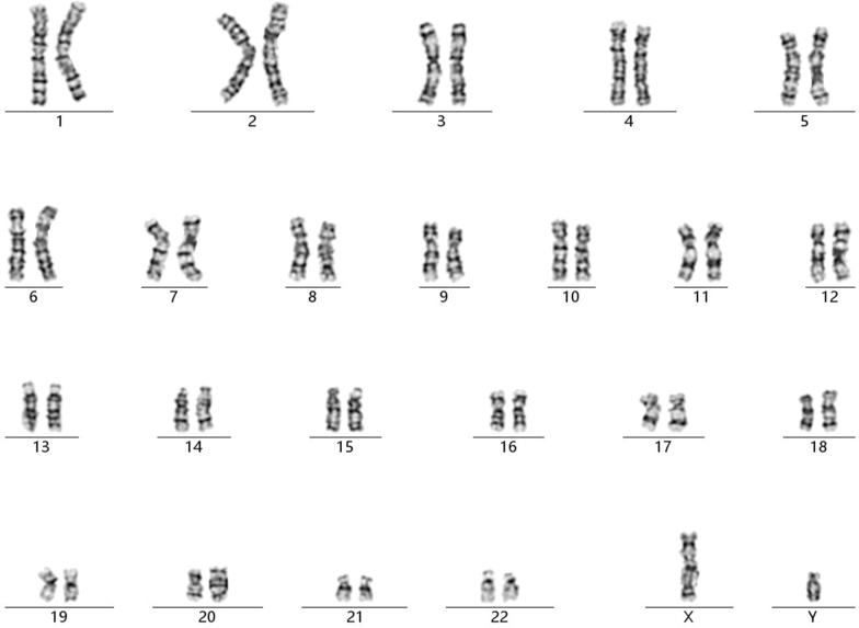 Prenatal diagnosis and genetic counseling of a paternally inherited microduplication 18q11.1 to 18q11.2 in a chinese family.