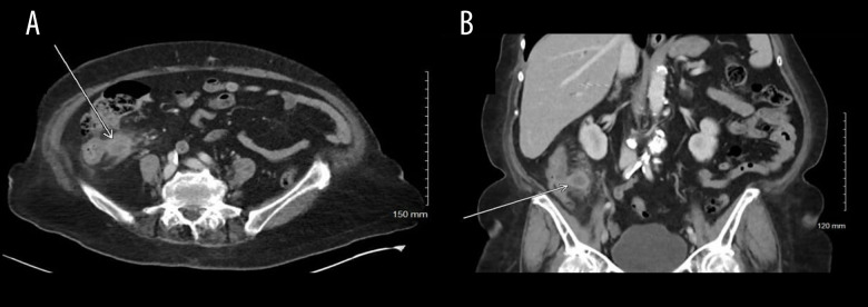 Sarcomatoid Carcinoma of the Ascending Colon: A Case Report and Literature Review.